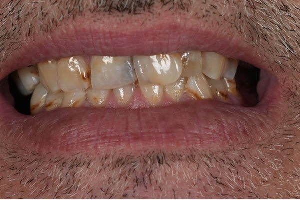 Laminat-Veneers – vorher